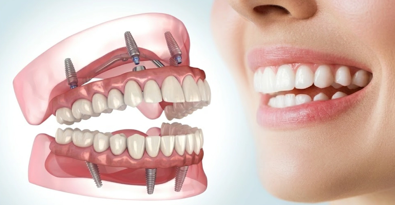 Full Mouth Restoration in Turkey 2